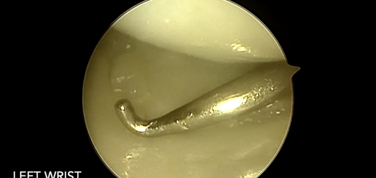 EWAS Classification of Scapholunate Ligament Injuries Study